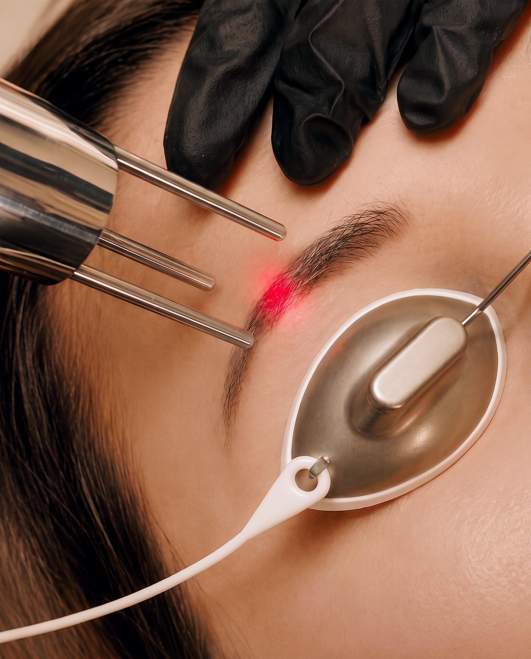 Laser PMU & Tattoo verwijderen bij The Beauty Standard in Breda